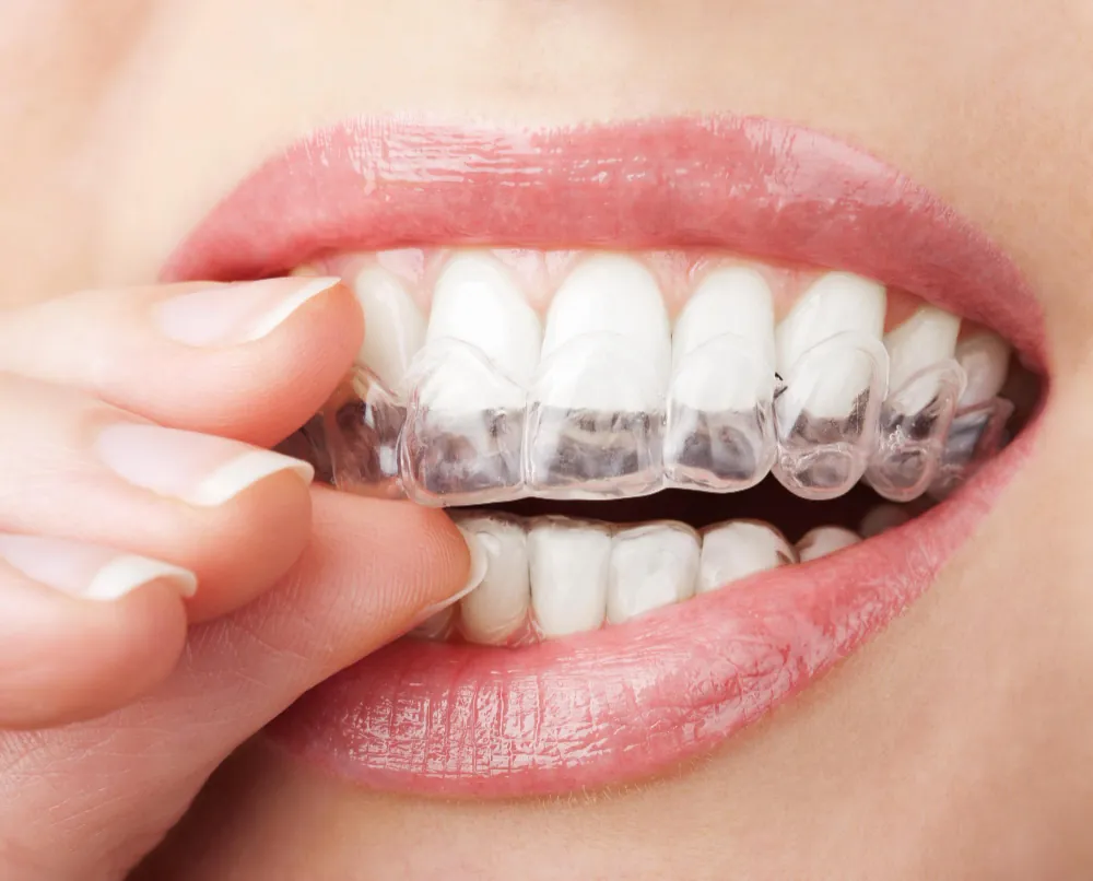 การจัดฟันด้วยระบบดิจิทัล (Digital Orthodontics)